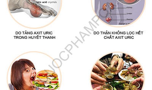 Đẩy l&#249;i bệnh Gout (G&#250;t) theo đ&#244;ng y an to&#224;n