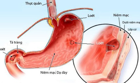 Giảm triệu chứng vi&#234;m lo&#233;t dạ d&#224;y, t&#225; tr&#224;ng