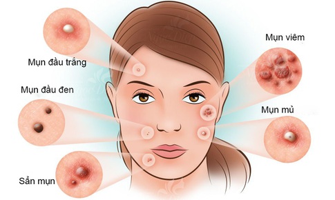 Đẩy l&#249;i mụn trứng c&#225; theo nguy&#234;n l&#253; Đ&#244;ng Y