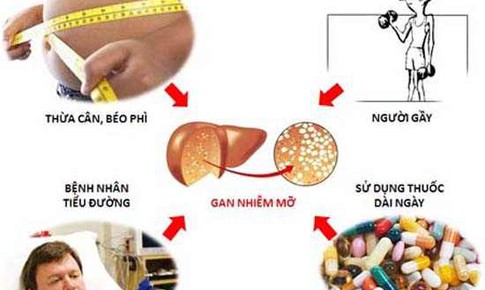 Đẩy l&#249;i xơ gan, gan nhiễm mỡ nhờ Đ&#244;ng y