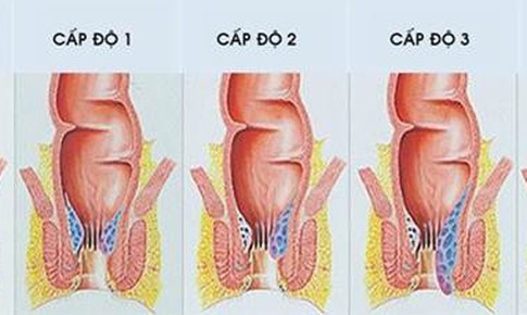 Phương ph&#225;p mới đẩy l&#249;i bệnh Trĩ hiệu quả bằng B&#224;o tử lợi khuẩn đ&#227; được chứng minh