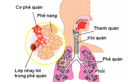 Thảo dược đẩy l&#249;i hen suyễn – hen phế quản COPD