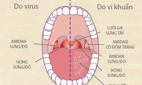 Kh&#225;ng vi&#234;m, ti&#234;u vi&#234;m - mấu chốt ph&#242;ng và đ&#226;̉y lùi vi&#234;m họng, vi&#234;m amidan