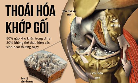 Đau mỏi, t&#234; cứng đầu gối, đi lại kh&#243; khăn phải l&#224;m sao?