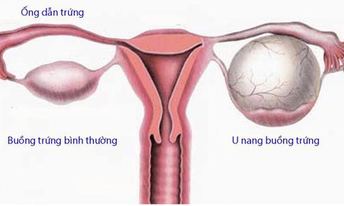 Khắc tinh của bệnh u nang buồng trứng, u xơ tử cung