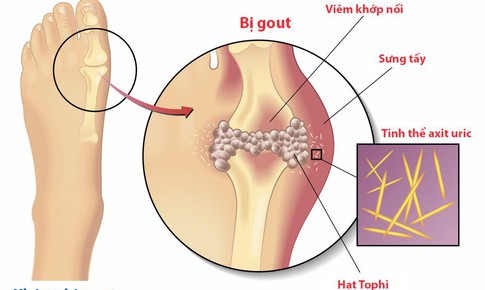 Giải m&#227; l&#253; do tại sao đẩy l&#249;i g&#250;t dễ thất bại trong việc kiểm so&#225;t bệnh?