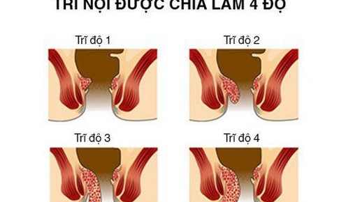 Bệnh trĩ nội độ 2 c&#243; nguy hiểm kh&#244;ng?