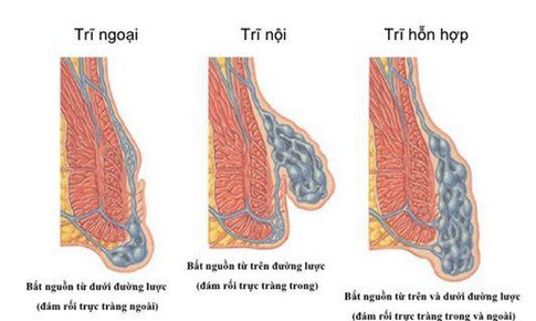 Đ&#226;u l&#224; triệu chứng của bệnh trĩ?