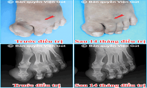 Điều trị hạ axit uric, tan cục tophi, phục hồi xương khớp cho người bị g&#250;t