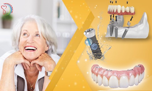 Kỹ thuật cấy implant cho người mất răng to&#224;n h&#224;m