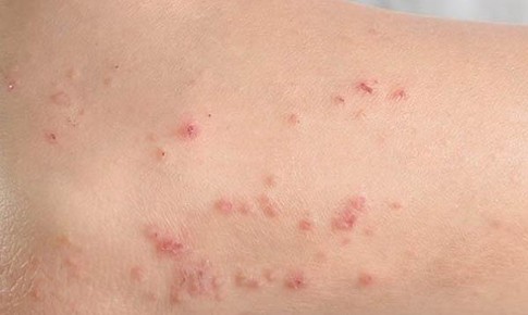 L&#224;m sao để ph&#242;ng ngừa v&#224; đẩy l&#249;i c&#225;c bệnh ngo&#224;i da do virus hiệu quả?