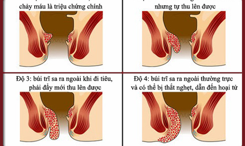 Trĩ cấp: nguy&#234;n nh&#226;n v&#224; c&#225;ch điều trị hữu hiệu