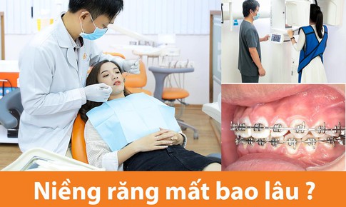 Niềng răng mất bao l&#226;u? - Bật m&#237; 07 bước trong quy tr&#236;nh niềng răng chuẩn y khoa