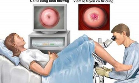 Đẩy l&#249;i vi&#234;m lộ tuyến cổ tử cung m&#224; kh&#244;ng cần “đốt”