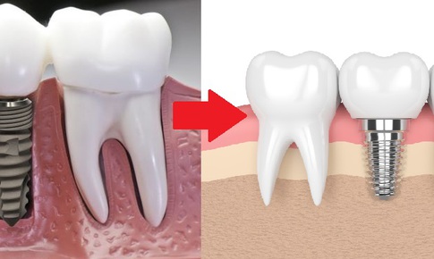 Trồng răng Implant “Phục hồi to&#224;n diện - Ho&#224;n thiện nụ cười”