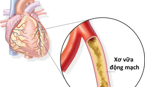 Những th&#244;ng tin kh&#244;ng thể bỏ qua cho người thiếu m&#225;u cơ tim