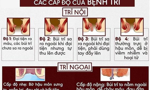 Những dấu hiệu nhận biết điển h&#236;nh của bệnh trĩ