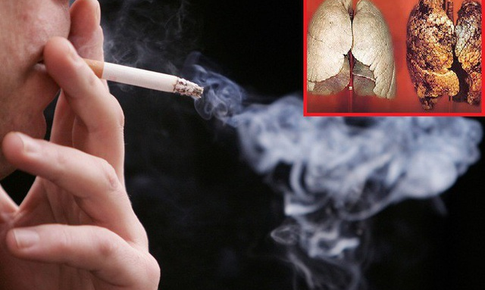 Biện ph&#225;p thảo dược hỗ trợ cho người bị ung thư phổi