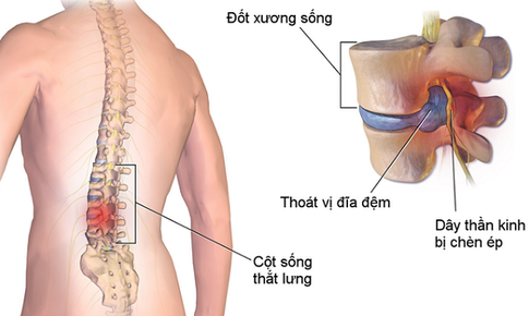 Giải ph&#225;p d&#224;nh cho người mắc bệnh xương khớp