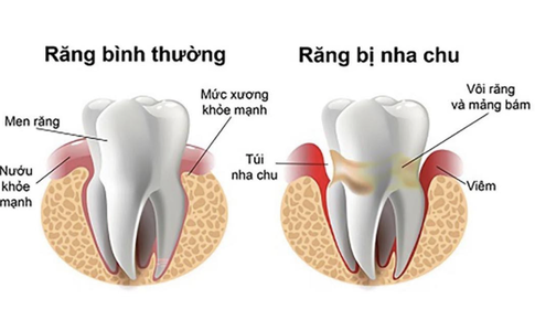 Bệnh vi&#234;m nha nhu v&#224; c&#225;ch điều trị