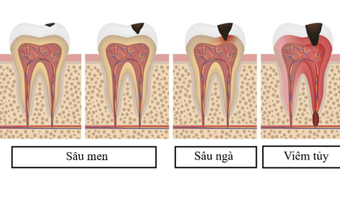 To&#224;n cảnh về bệnh s&#226;u răng v&#224; biện ph&#225;p đề ph&#242;ng