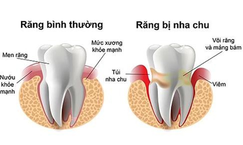 Bệnh vi&#234;m nha chu ở người mắc bệnh đ&#225;i th&#225;o đường