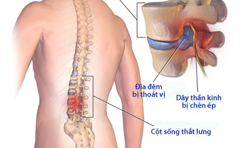 Hậu quả v&#224; c&#225;c biến chứng của bệnh tho&#225;i h&#243;a cột sống lưng v&#224; cột sống cổ