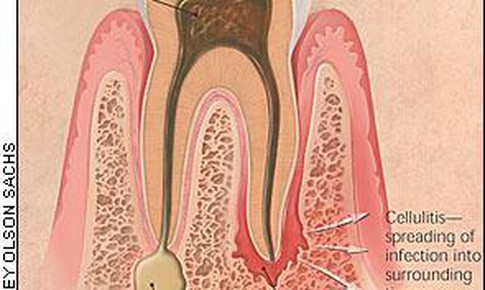 Vi&#234;m m&#244; tế b&#224;o lan tỏa v&#249;ng h&#224;m mặt –  Biến chứng bệnh l&#253; răng miệng