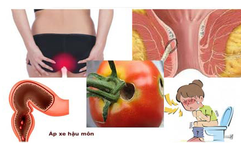 Bài thuốc Nam gia truyền chữa bệnh mạch lươn hiệu quả