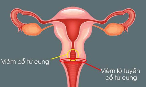 Nguy cơ v&#244; sinh v&#236; vi&#234;m lộ tuyến cổ tử cung