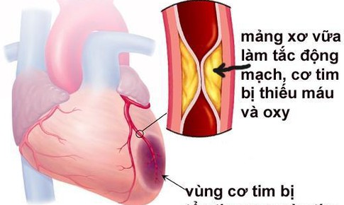 Mỡ m&#225;u cao tăng nguy cơ tai biến, đột quỵ