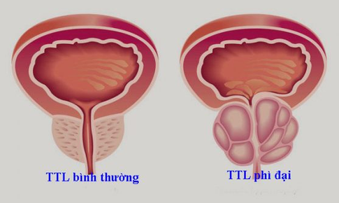 Giảm ngay c&#225;c triệu chứng của bệnh u xơ tiền liệt tuyến