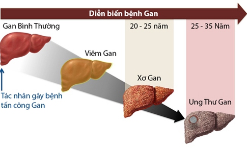 Những điều cần biết để c&#243; l&#225; gan khỏe mạnh