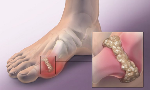 Hỗ trợ giảm triệu chứng gout hiệu quả từ dược liệu c&#243; trong vườn nh&#224;