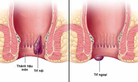 Bệnh trĩ l&#224; g&#236;? Dấu hiệu, nguy&#234;n nh&#226;n v&#224; c&#225;ch khắc phục?