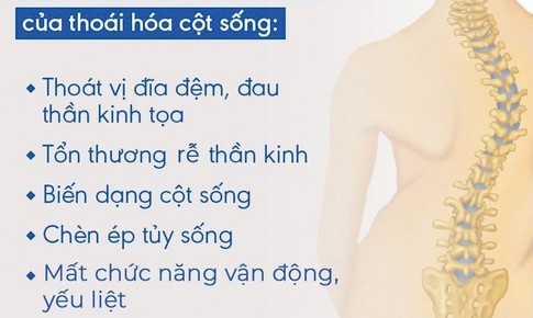 Tho&#225;i h&#243;a cột sống n&#234;n uống thuốc g&#236;?