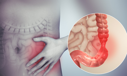 Vi&#234;m đại tr&#224;ng l&#224; g&#236;? Triệu chứng, nguy&#234;n nh&#226;n v&#224; c&#225;ch khắc phục?