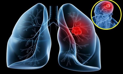 Mỗi năm Việt Nam ghi nhận gần 24.000 trường hợp mắc ung thư phổi