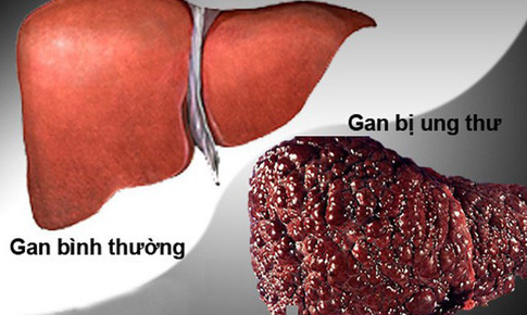 Căn bệnh ung thư n&#224;o c&#243; tỷ lệ mắc mới lớn nhất hiện nay tại Việt Nam?