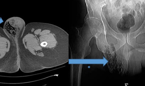 Nam bệnh nh&#226;n nước ngo&#224;i mắc bệnh l&#253; Fournier g&#226;y hoại tử nặng