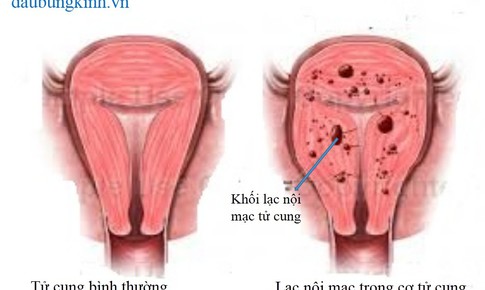 Lạc tuyến nội mạc tử cung trong cơ tử cung l&#224; bệnh g&#236;?