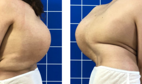 Giải thoát khối “mai rùa” trên lưng cô gái 22 tuổi