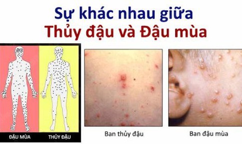 FDA ph&#234; duyệt thuốc đầu ti&#234;n trị bệnh đậu m&#249;a