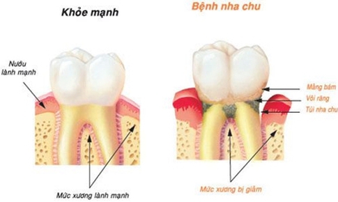 Bệnh nướu răng l&#224;m tăng nguy cơ sa s&#250;t tr&#237; tuệ