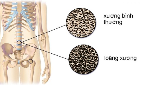 FDA ph&#234; duyệt thuốc evenity trị lo&#227;ng xương sau m&#227;n kinh