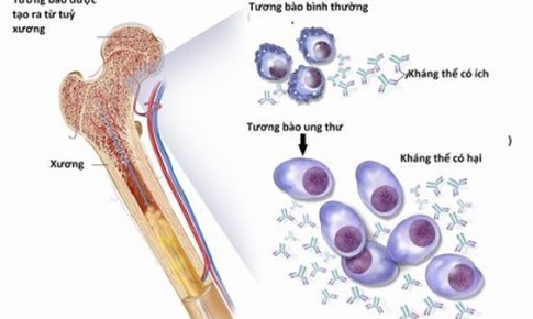 FDA chấp thuận điều trị mới cho đa u tủy