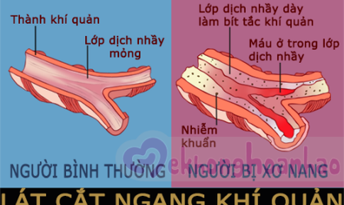 Thuốc trị bệnh xơ nang cho bệnh nh&#226;n từ 6 tuổi trở l&#234;n