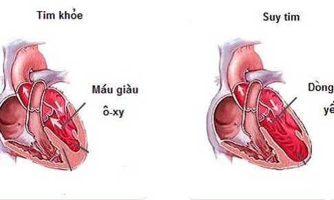 FDA ph&#234; duyệt farxiga trị suy tim