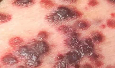 Thuốc mới trị ung thư Kaposi liên quan tới HIV/AIDS