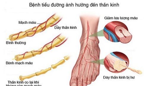 Thuốc trị bệnh thần kinh ngoại bi&#234;n b&#224;n ch&#226;n tiểu đường